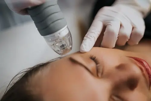 What Is CosmoPen Microneedling - An Advanced Procedure to Help Reduce Wrinkles What Is CosmoPen Microneedling - An Advanced Procedure to Help Reduce Wrinkles