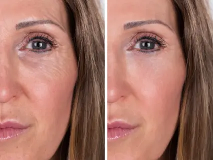 Common Areas Treated by EZ Gel PRF - Natural Beauty NYC