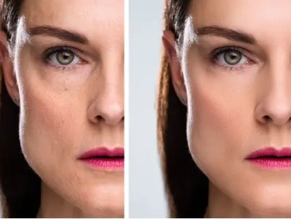 How EZ Gel PRF Enhances Appearance - Natural Beauty NYC 
